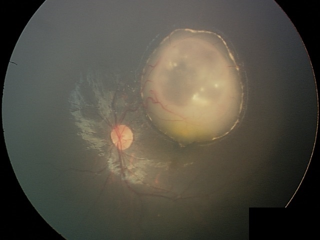 Retinoblastoma, A Success Story In The Fight Against&nbsp;Cancer