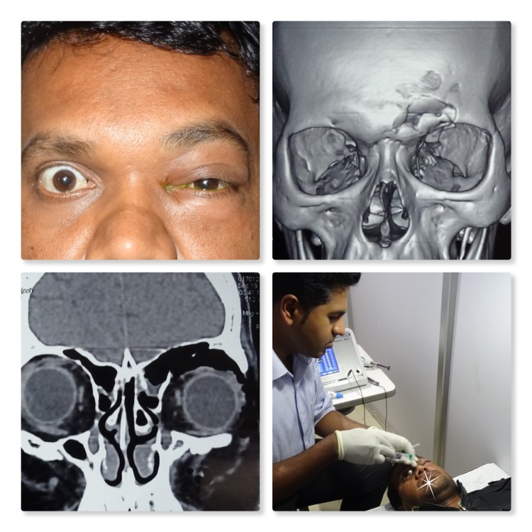 Orbital Emphysema Collage