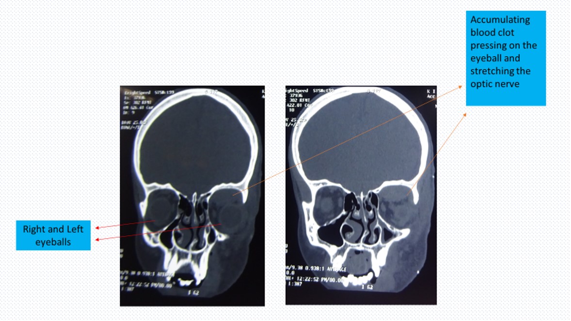 Coronal showing Subperiosteal Hematoma