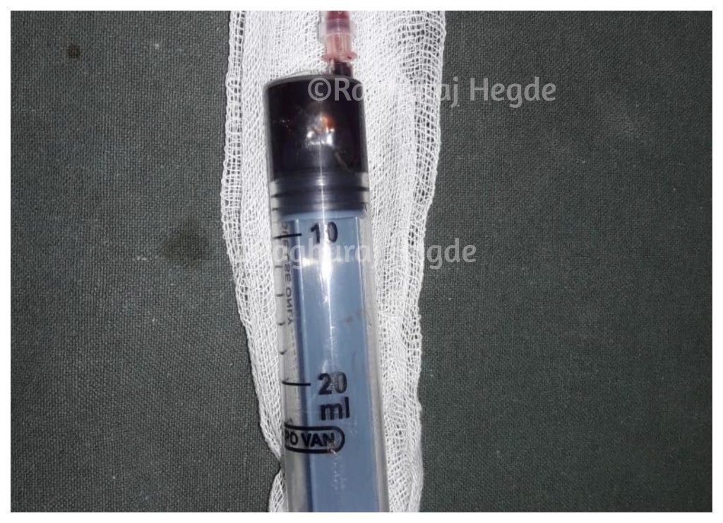 I could evacuate about 20ml of blood from the left orbit. For reference an orbital volume in an adult is 30ml. The above picture is the first syringe.