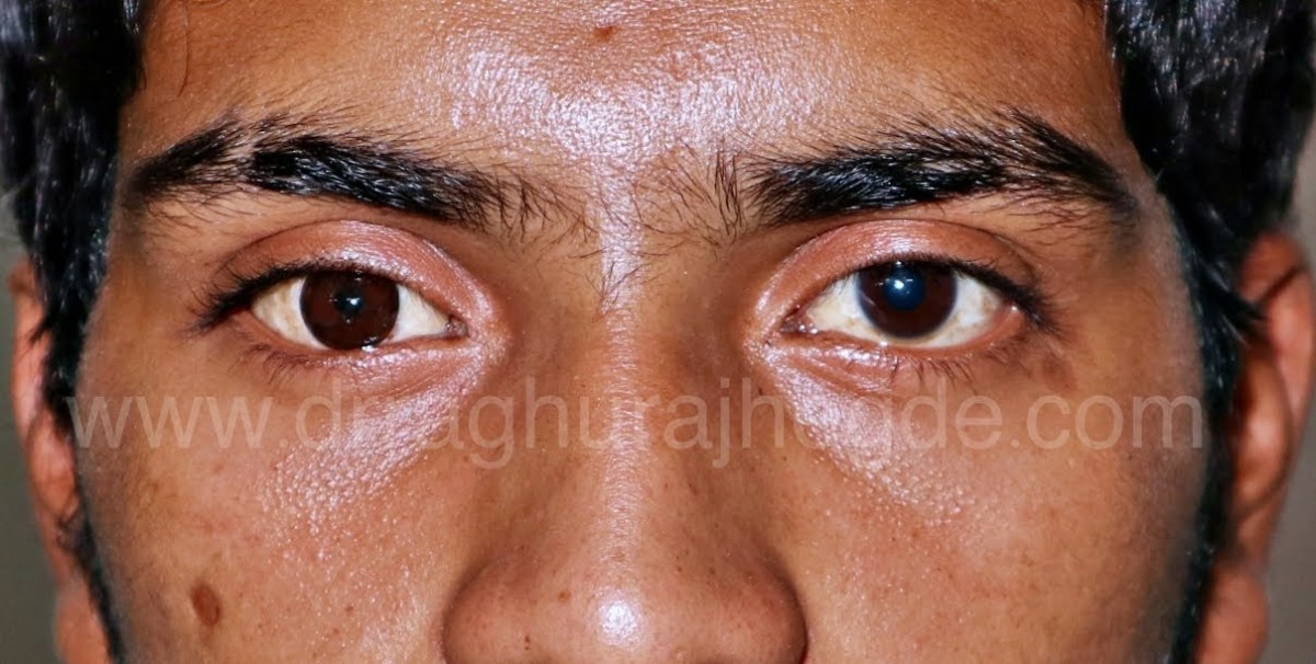 Which one is the real&nbsp;eye?